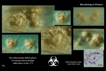 Mycobacterium